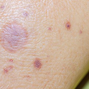 What is Mottling of the Skin? Causes, Symptoms and Treatment - The ...